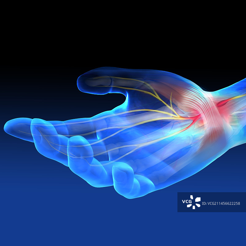 腕管综合征插图图片素材