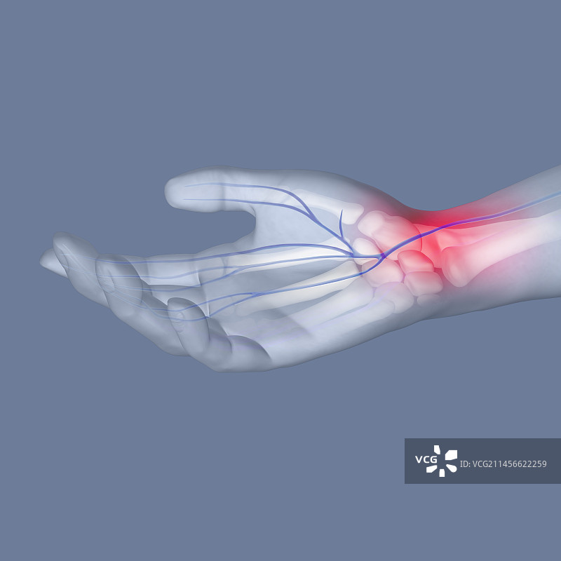 腕管综合征插图图片素材