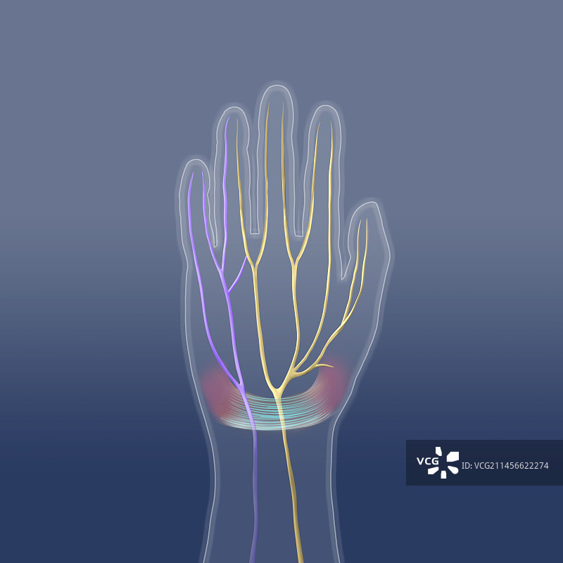 腕管综合征插图图片素材