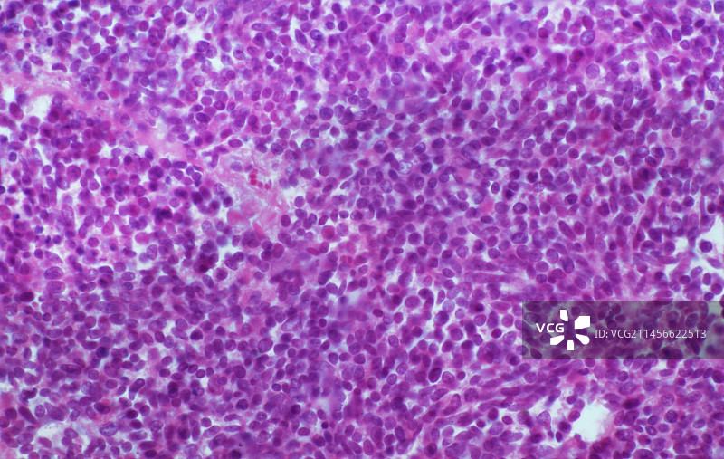 转移性肺癌图片素材