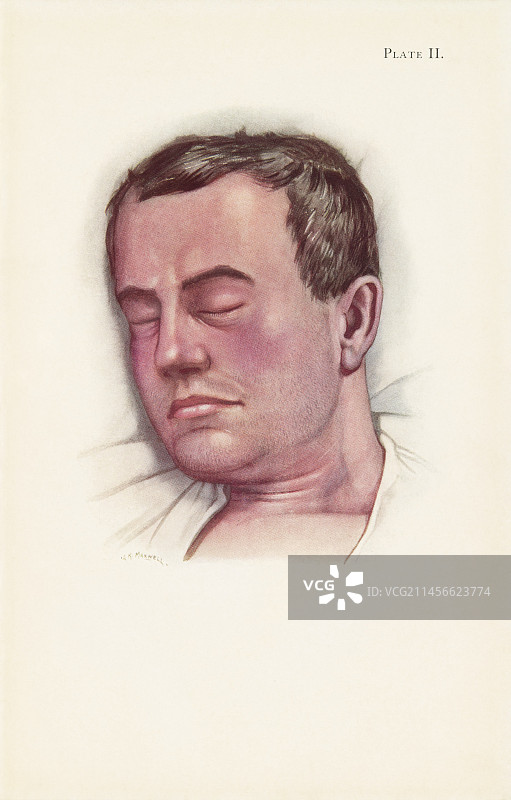 第一次世界大战中的光气患者插图图片素材