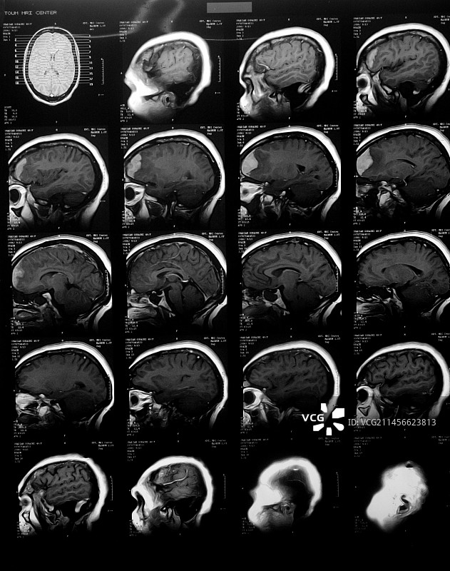 双侧视神经乳头水肿，MRI扫描图片素材