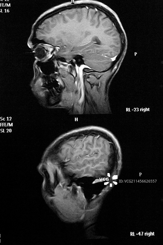 骨髓瘤，MRI扫描图片素材