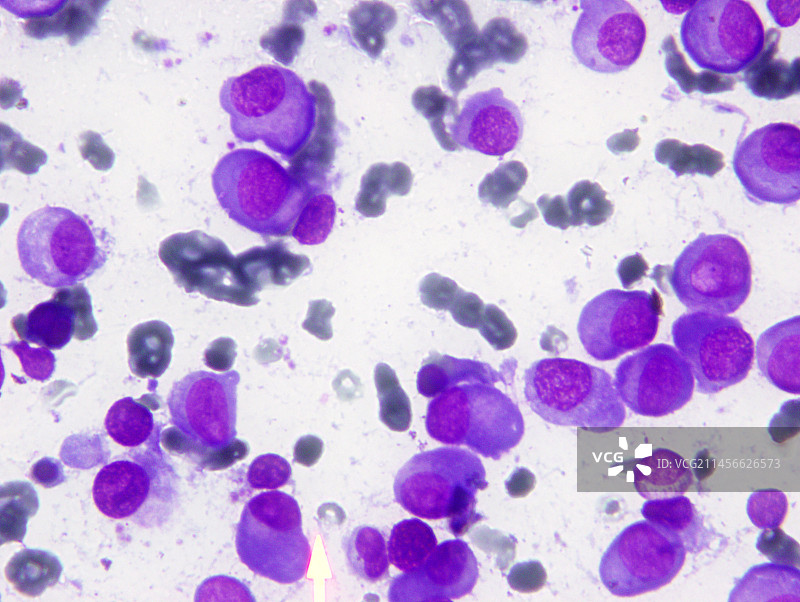 多发性骨髓瘤显微照片图片素材