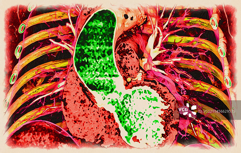 主动脉动脉瘤CT扫描图片素材