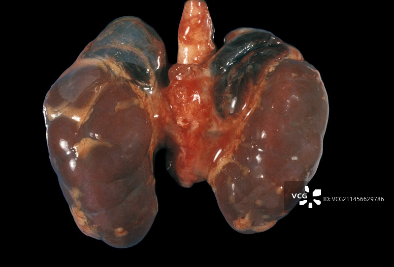 Waterhouse-Friderichsen综合征中的肾上腺图片素材