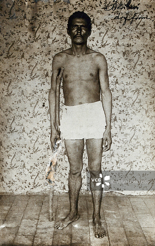 干性脚气病患者图片素材