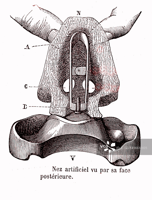 人造鼻子，19世纪插图图片素材