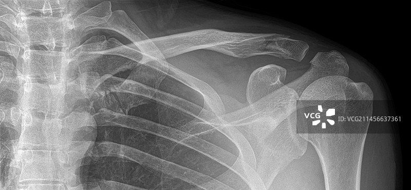 锁骨骨折X光片图片素材