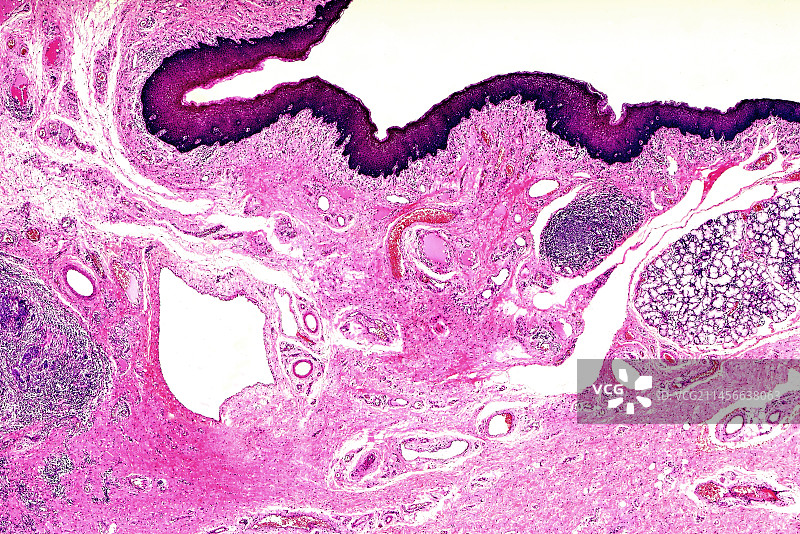 喉咽癌显微照片图片素材
