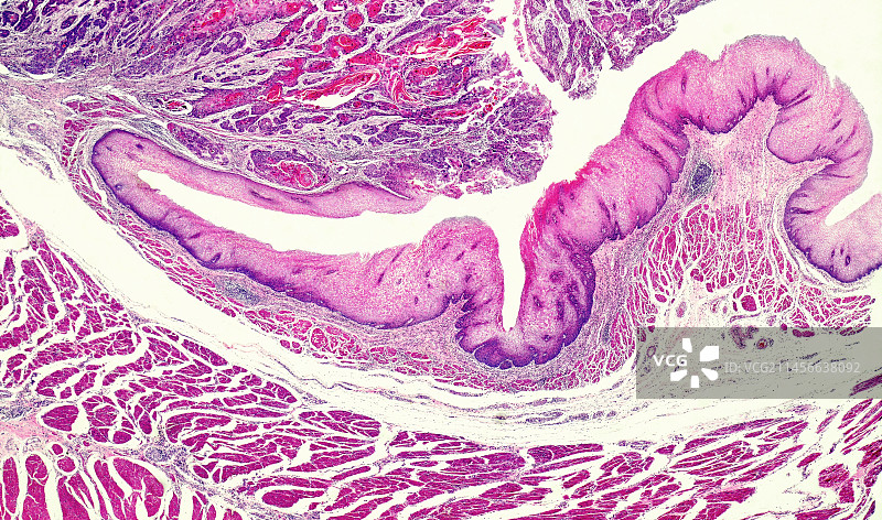 口腔和口咽癌，光学显微照片图片素材