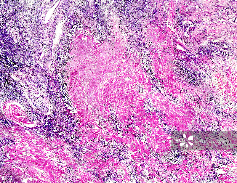 肺硅酸沉着症的光学显微照片图片素材