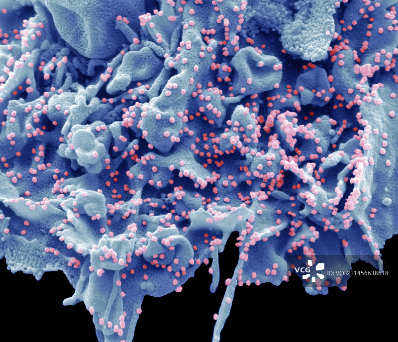 新冠第一阶段英国变异株，扫描电子显微镜图片素材