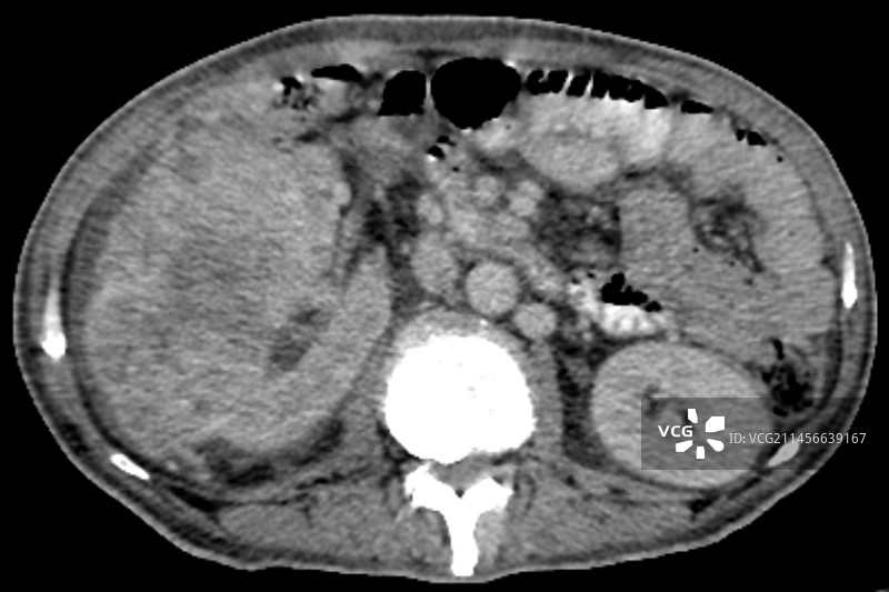 肾细胞癌CT扫描图片素材