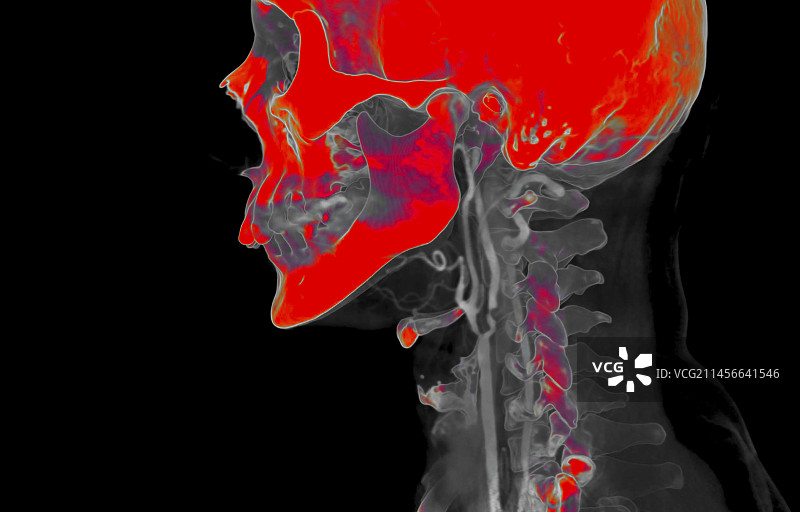 闭塞的颈动脉，CT血管造影图片素材