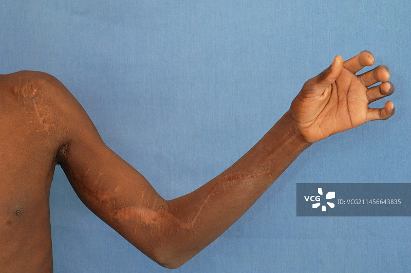 烧伤疤痕图片素材