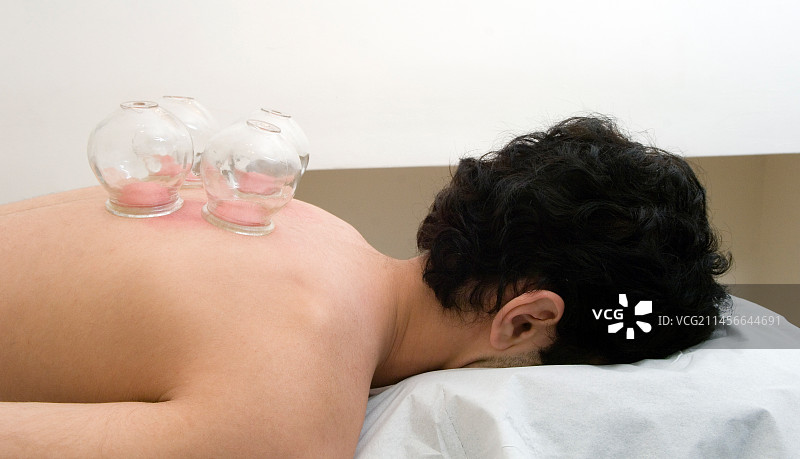 拔罐图片素材