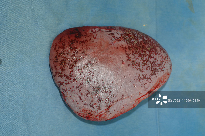 切除的脾脏图片素材