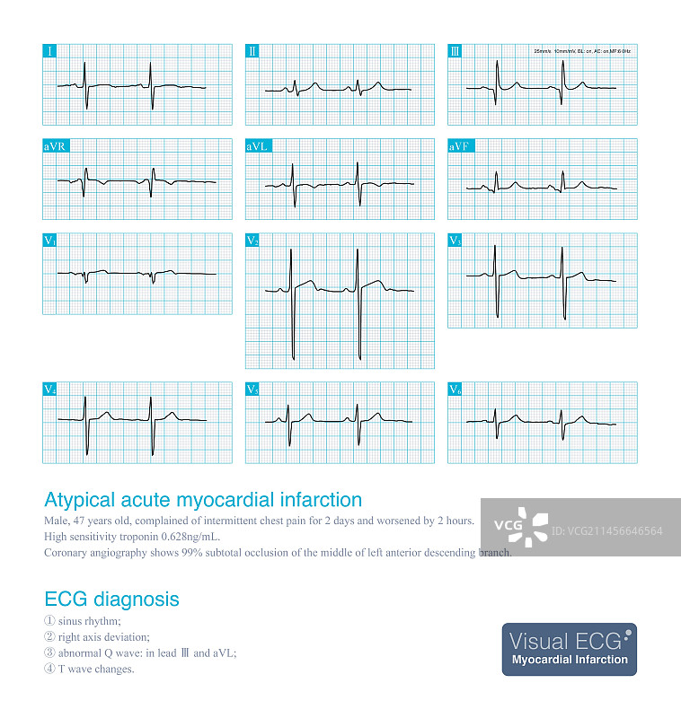 非典型急性心肌梗死插图图片素材