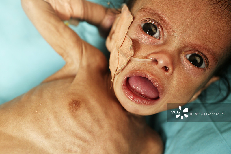 发育不良图片素材