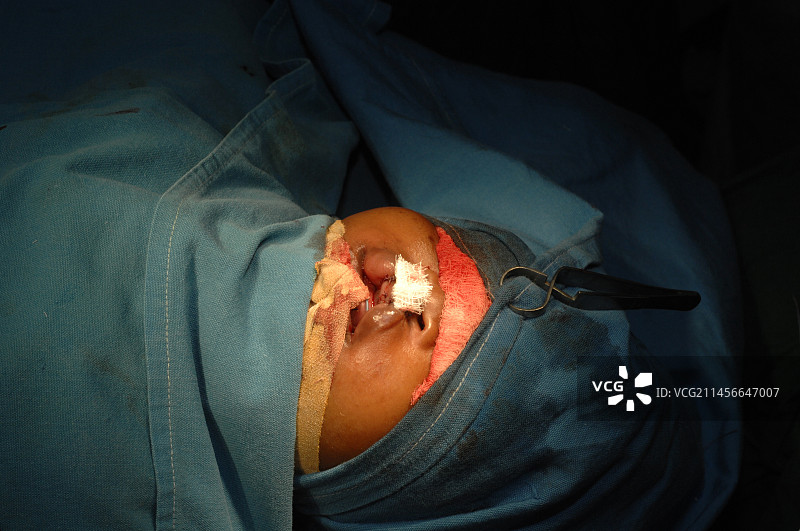 唇裂修复手术图片素材
