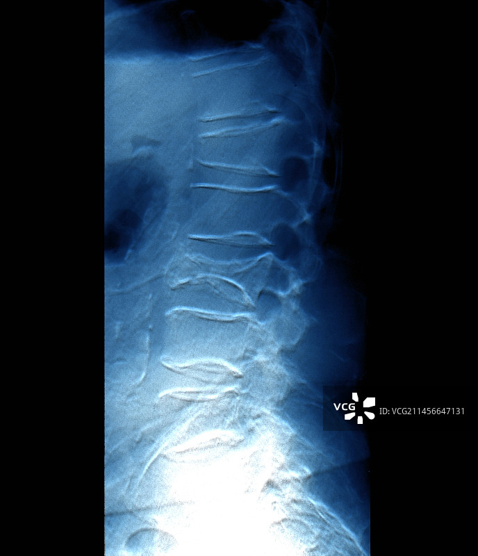 骨质疏松症X光片图片素材