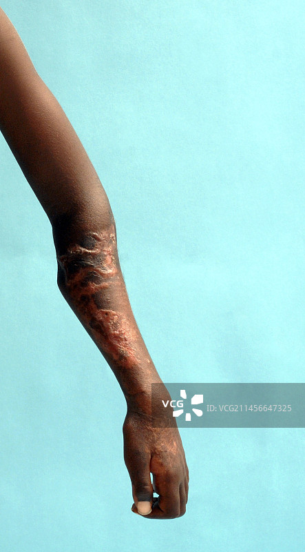 上肢缺血图片素材