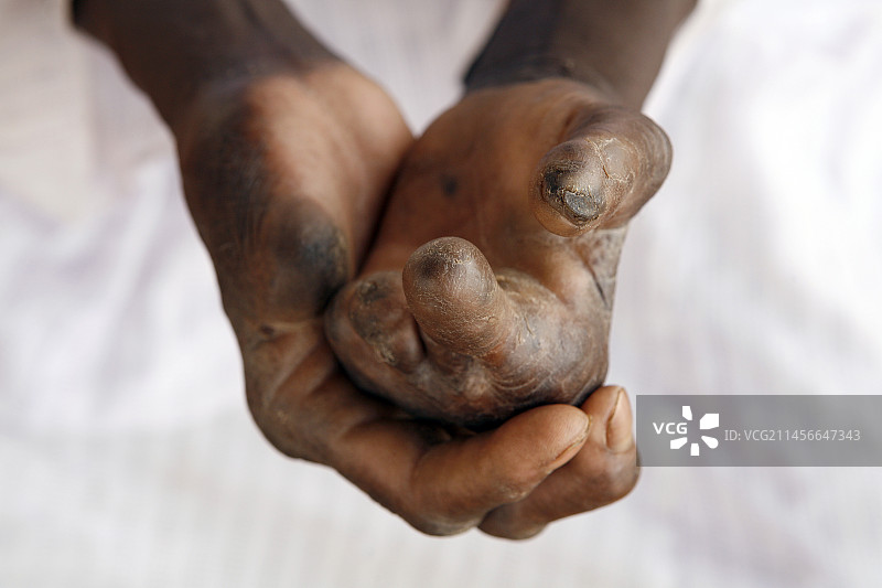 麻风病图片素材