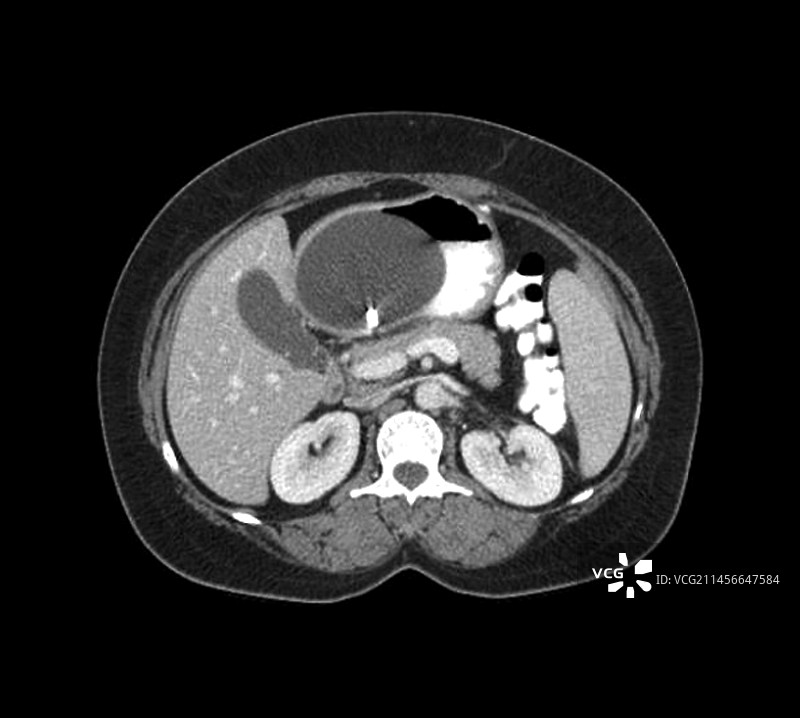 胃球囊CT扫描图片素材