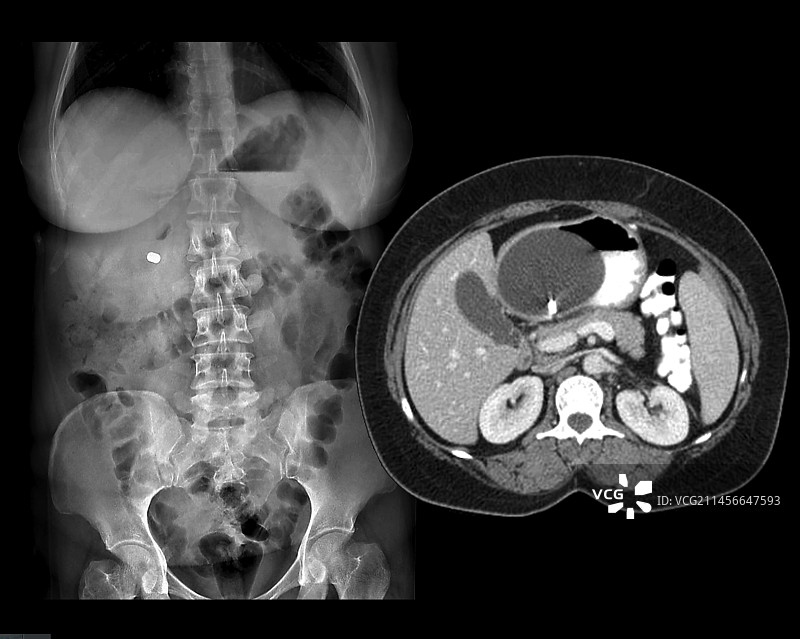 胃球囊，CT扫描图片素材