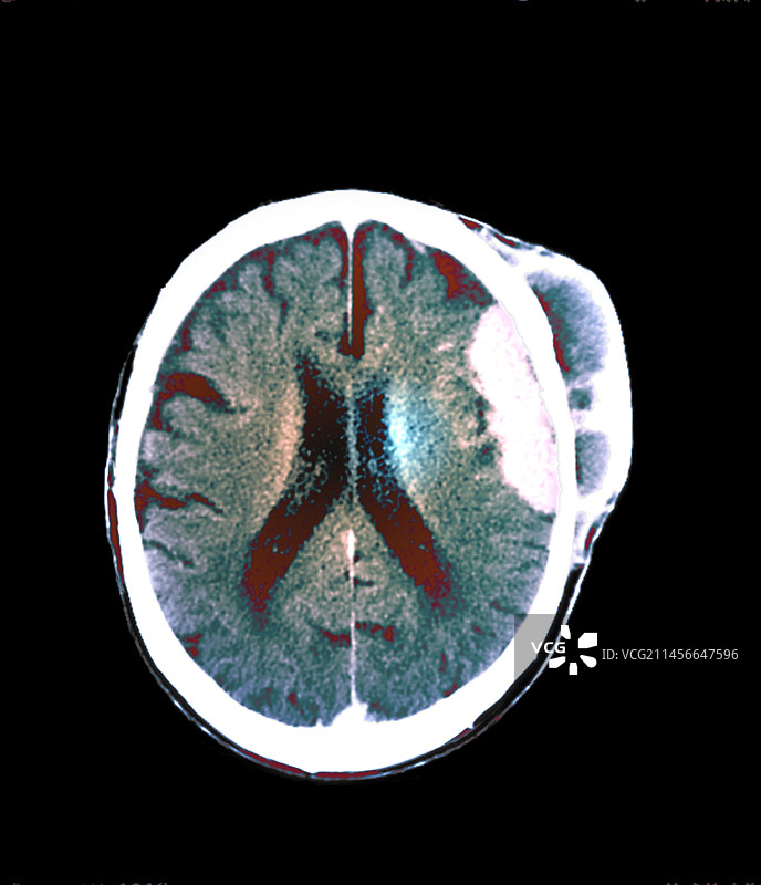 默克尔头部癌症CT扫描图片素材