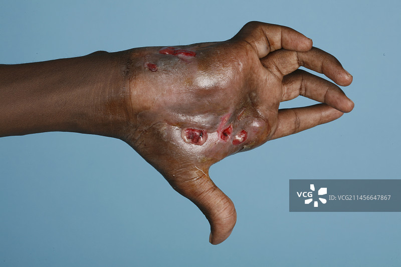 足菌肿患者的手图片素材