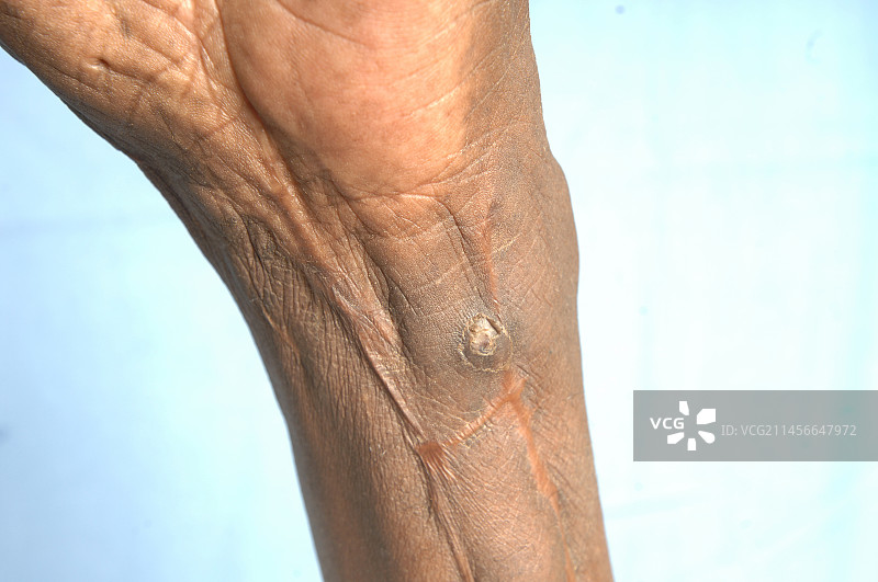 真菌病图片素材