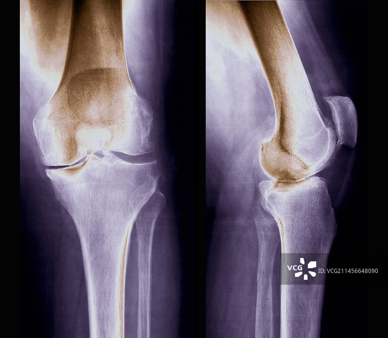骨关节炎X光片图片素材