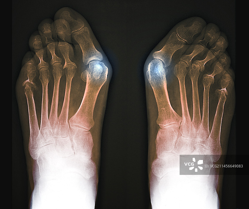 拇囊炎X光片图片素材