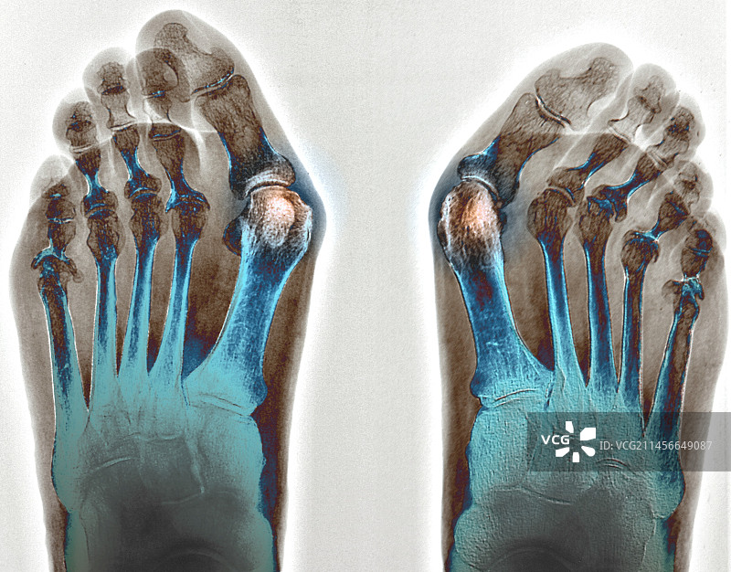 拇囊炎X光片图片素材