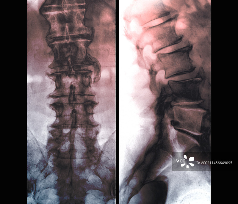 骨刺X光片图片素材