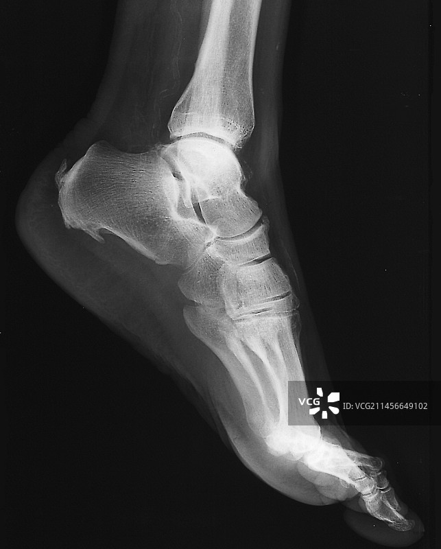足跟疼痛X光片图片素材