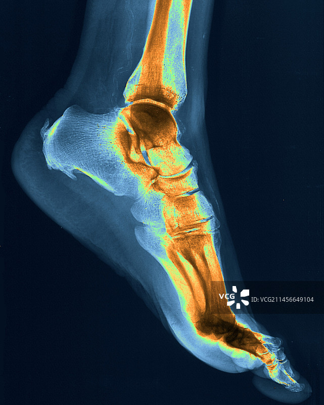 足跟疼痛X光片图片素材