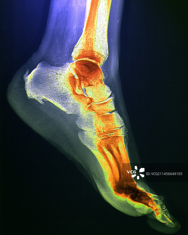 足跟疼痛X光片图片素材