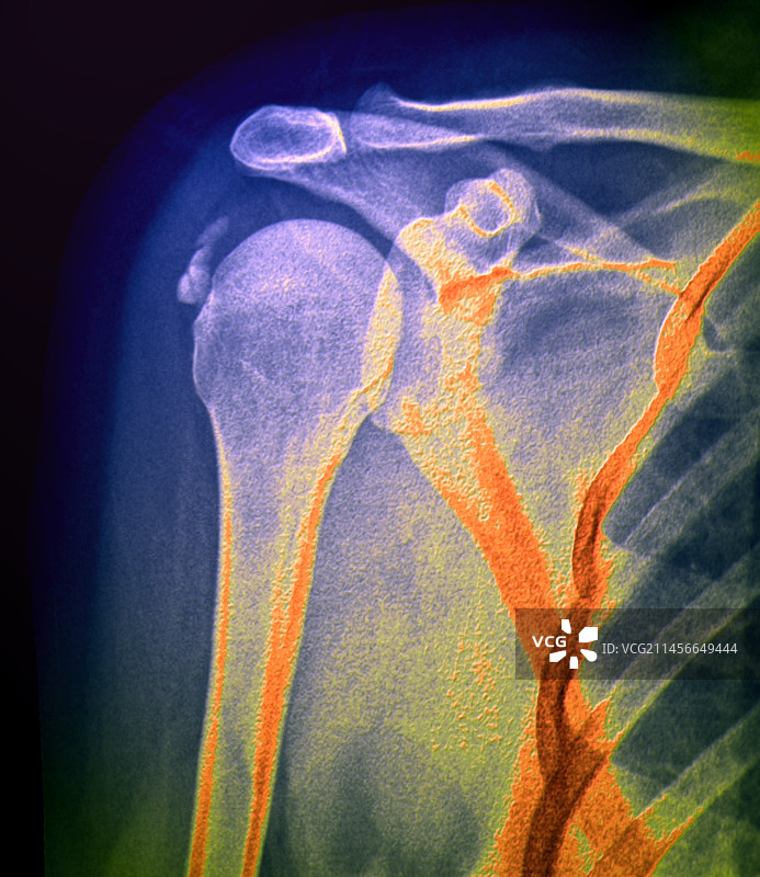 钙化性肌腱炎X光片图片素材