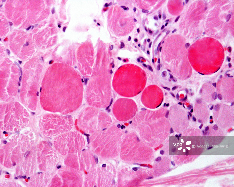 肌肉萎缩症的光学显微照片图片素材