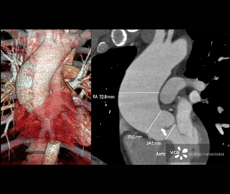 主动脉瘤CT血管造影图片素材