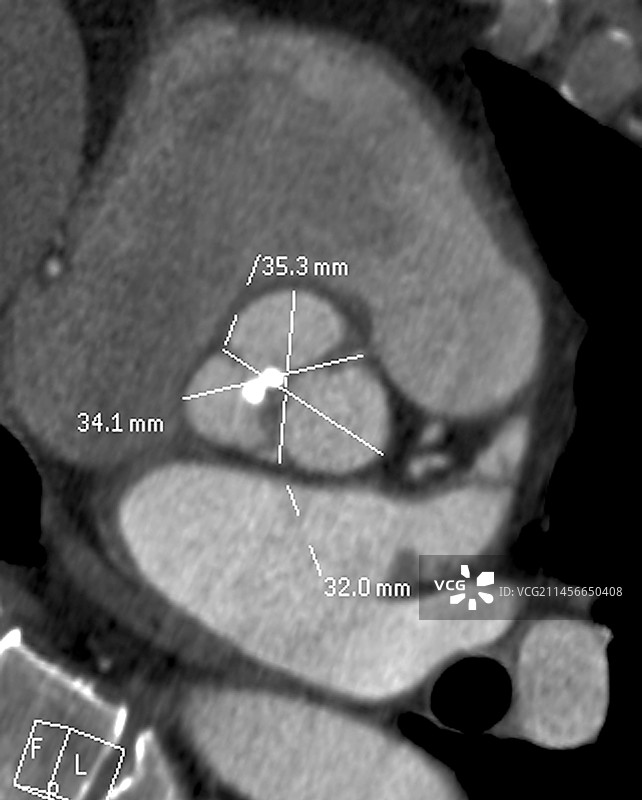主动脉瘤CT血管造影图片素材