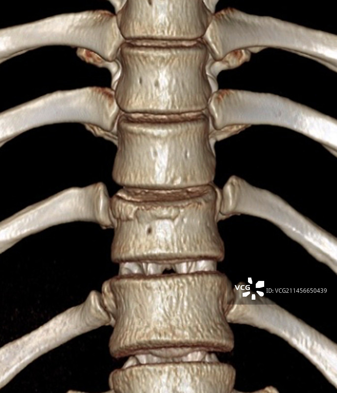 胸椎骨折3D CT扫描图片素材
