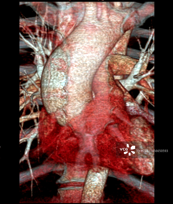 主动脉瘤3D CT血管造影扫描图片素材