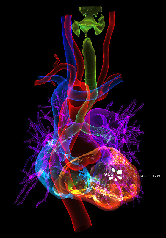 先天性心脏缺陷3D CT扫描图片素材