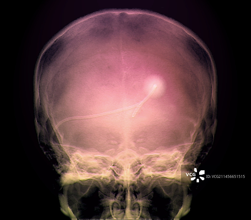 脑室外引流X光片图片素材