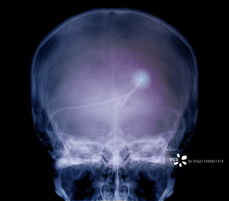 脑室外引流X光片图片素材