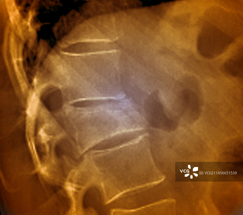 腰椎骨折X光片图片素材